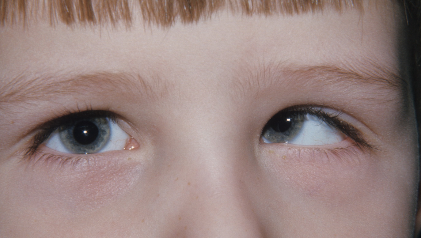 Duane Retraction Syndrome 1 Hereditary Ocular Diseases